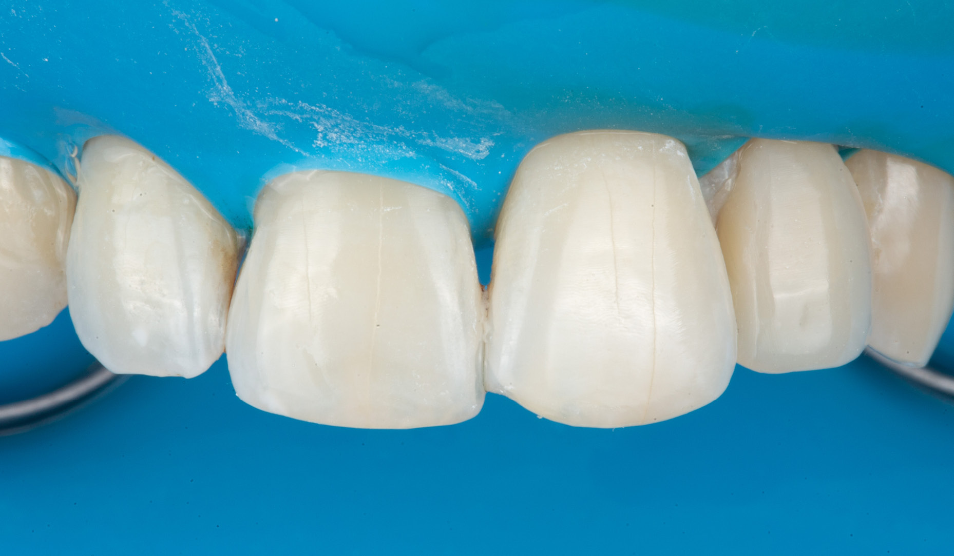 Simplifying Complexity: Peg-Shaped Lateral Incisor Restored With Universal Composite (6-Month Follow-Up)